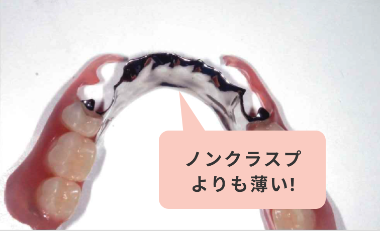 下顎の金属床＋ノンクラスプデンチャー