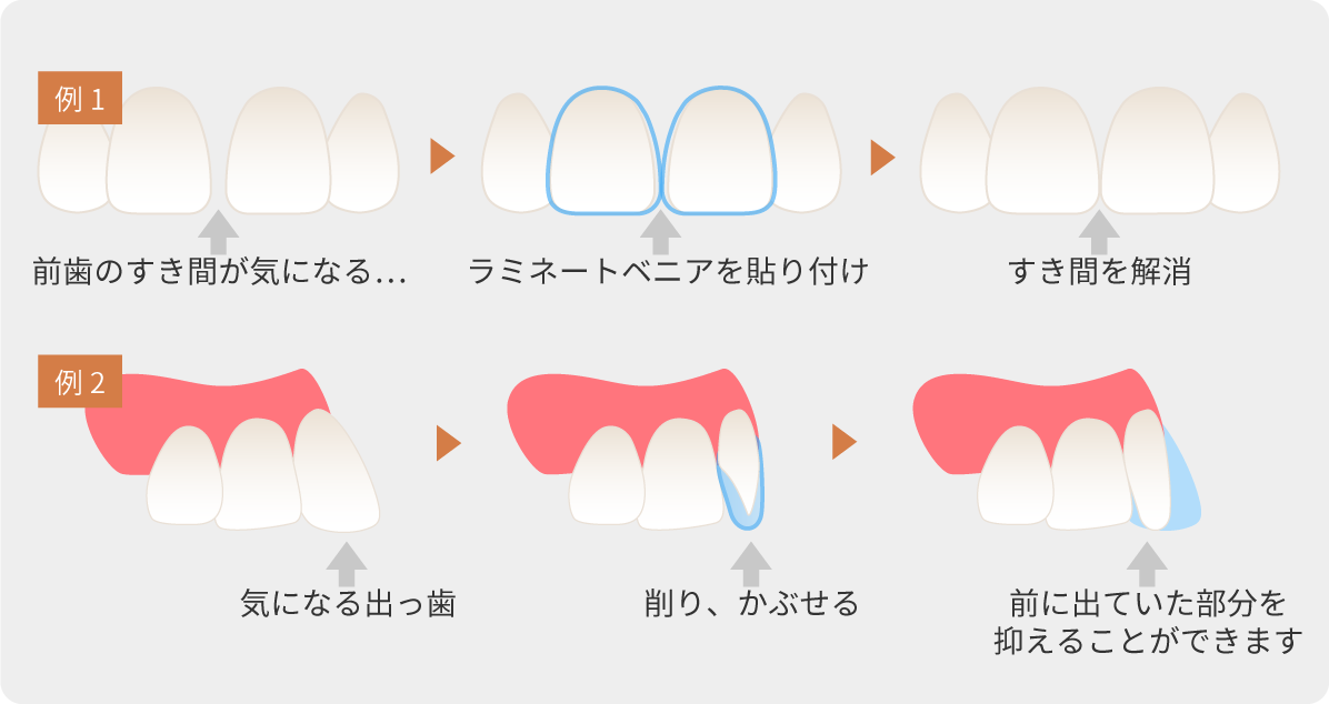 前歯の隙間をラミネートベニアで解消したり、出っ歯を削りラミネートベニアを被せることで前に出ていた部分を抑えるなどの症例があります