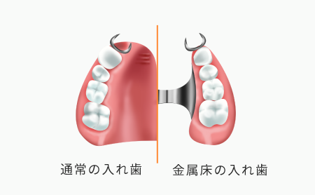 金属床義歯と通常の入れ歯の比較