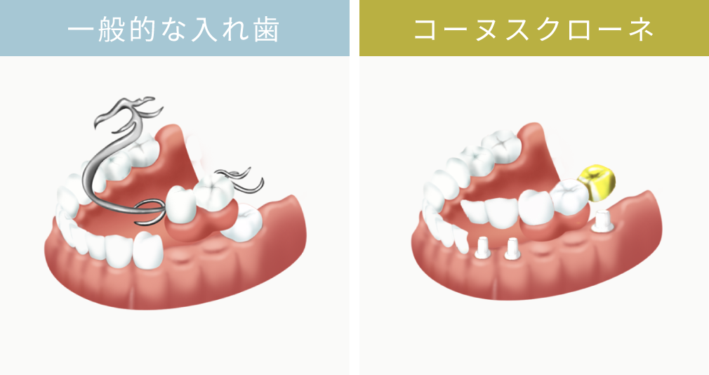 一般的な入れ歯とコーヌスクローネとの比較